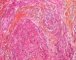 Epithelioid sarcoma