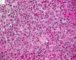 Femoral Langerhans histiocytosis