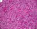 Femoral Langerhans histiocytosis
