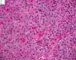Femoral Langerhans histiocytosis