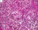 Femoral Langerhans histiocytosis