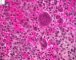 Femoral Langerhans histiocytosis
