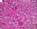 Femoral Langerhans histiocytosis