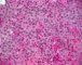 Femoral Langerhans histiocytosis
