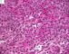 Femoral Langerhans histiocytosis