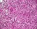 Femoral Langerhans histiocytosis