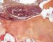 Spindle cell hemangioendothelioma in Maffucci syndrome