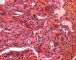 Spindle cell hemangioendothelioma in Maffucci syndrome
