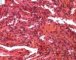 Spindle cell hemangioendothelioma in Maffucci syndrome