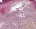 Spindle cell hemangioendothelioma in Maffucci syndrome