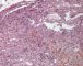 Spindle cell hemangioendothelioma in Maffucci syndrome