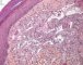 Spindle cell hemangioendothelioma in Maffucci syndrome