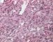 Spindle cell hemangioendothelioma in Maffucci syndrome