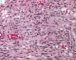 Spindle cell hemangioendothelioma in Maffucci syndrome