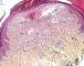 Spindle cell hemangioendothelioma in Maffucci syndrome