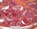 Spindle cell hemangioendothelioma in Maffucci syndrome