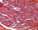 Spindle cell hemangioendothelioma in Maffucci syndrome