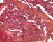 Spindle cell hemangioendothelioma in Maffucci syndrome