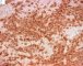 Femoral Langerhans histiocytosis