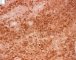 Femoral Langerhans histiocytosis