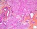Portal and septal fibrosis in ductal plate malformation (congenital hepatic (...)