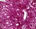 Hepatic glycogenosis (PAS)