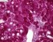 Hepatic glycogenosis (PAS)
