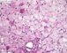 Hepatic glycogenosis (PAS + diastase)