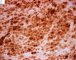 Femoral Langerhans histiocytosis