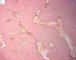 INI1/SNF5 (SMARCB1) negative immunostaining