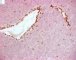 INI1/SNF5 (SMARCB1) negative immunostaining