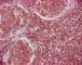 INI1/SNF5 in desmoplastic medulloblastoma