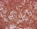 INI1/SNF5 in desmoplastic medulloblastoma