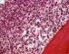Bone marrow infiltration by large myeloid cells in Kostmann (...)