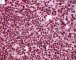 Bone marrow infiltration by large myeloid cells in Kostmann (...)