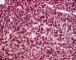 Bone marrow infiltration by large myeloid cells in Kostmann (...)