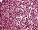 Bone marrow infiltration by large myeloid cells in Kostmann (...)