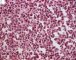 Bone marrow infiltration by large myeloid cells in Kostmann (...)
