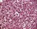 Bone marrow infiltration by large myeloid cells in Kostmann (...)