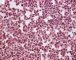 Bone marrow infiltration by large myeloid cells in Kostmann (...)
