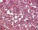 Bone marrow infiltration by large myeloid cells in Kostmann (...)