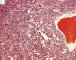 Bone marrow infiltration by large myeloid cells in Kostmann (...)