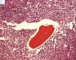 Bone marrow infiltration by large myeloid cells in Kostmann (...)