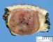 Lobular capillary hemangioma