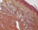 Multifocal lymphangioendotheliomatosis with thrombocytopenia