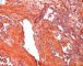 Multifocal lymphangioendotheliomatosis with thrombocytopenia