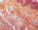 Multifocal lymphangioendotheliomatosis
