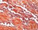 Multifocal lymphangioendotheliomatosis with thrombocytopenia