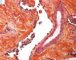 Multifocal lymphangioendotheliomatosis with thrombocytopenia