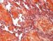 Multifocal lymphangioendotheliomatosis